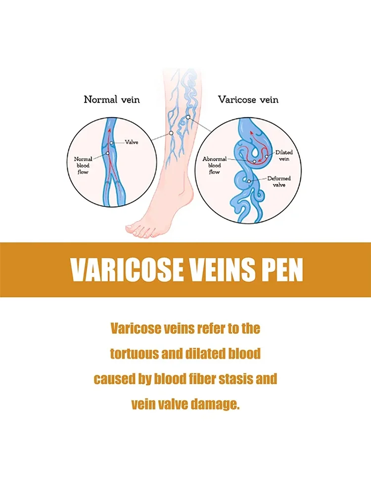 Крем-лазер Varicosse