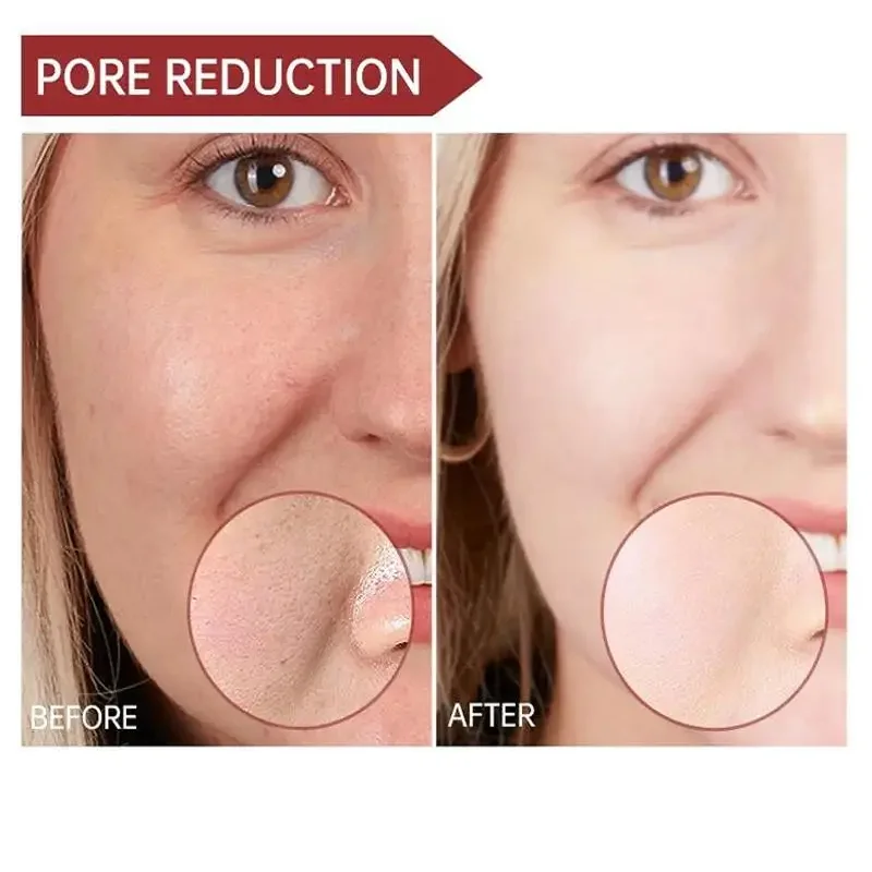 Средство для сужения пор с салициловой кислотой крем очищения удаление черных