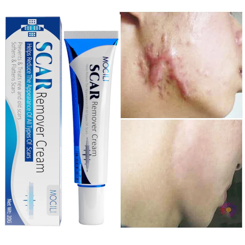 

Herbal Scar Remover Cream Burn Surgical Scar Stretch Marks Repair Acne Treatment Cesarean Scar Pigmentation Body Beauty Care Gel