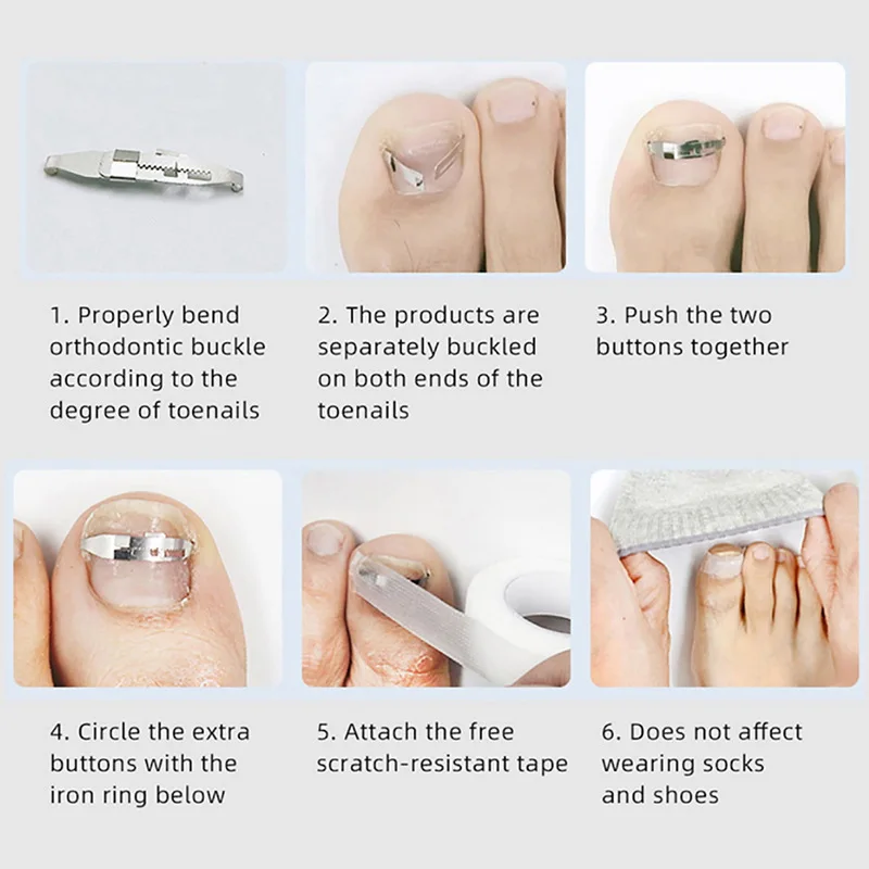 Toe Ingrown Pedicure Nail Buckle Toenails Corrector Foot Correction Tool Straightening Clip Curved Brace