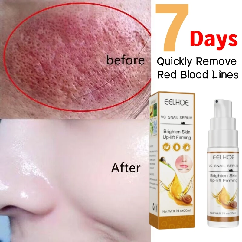 

Rosacea Treatment Snail Essence Lotion Repair Facial Redness Dry Sensitive Skin Intense Moisturizer Sooth Korean Care Cosmetics