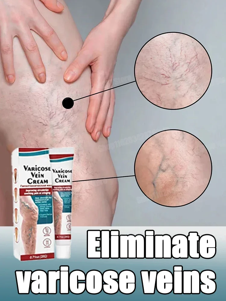 Varicose vein relief cream for leg spasms vasculitis phlebitis spider protrusion pain ointment 1