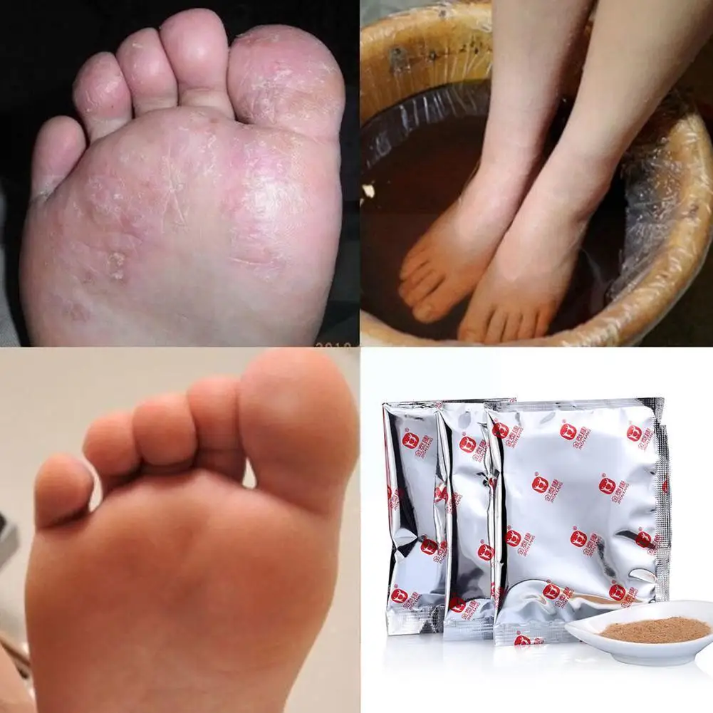

Foot Bath Powder Athlete's Foot, Foot Odor, Sweat, Pedis Itching, Feet Tinea Beriberi, Care Beriberi Peeling, Anti R3Z9