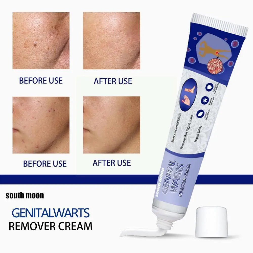 

New 20g Warts Remover Antibacterial Ointment Wart Treatment Herbal Cream Remover Corn Skin Care Tag Skin Extract Plaster K2C7