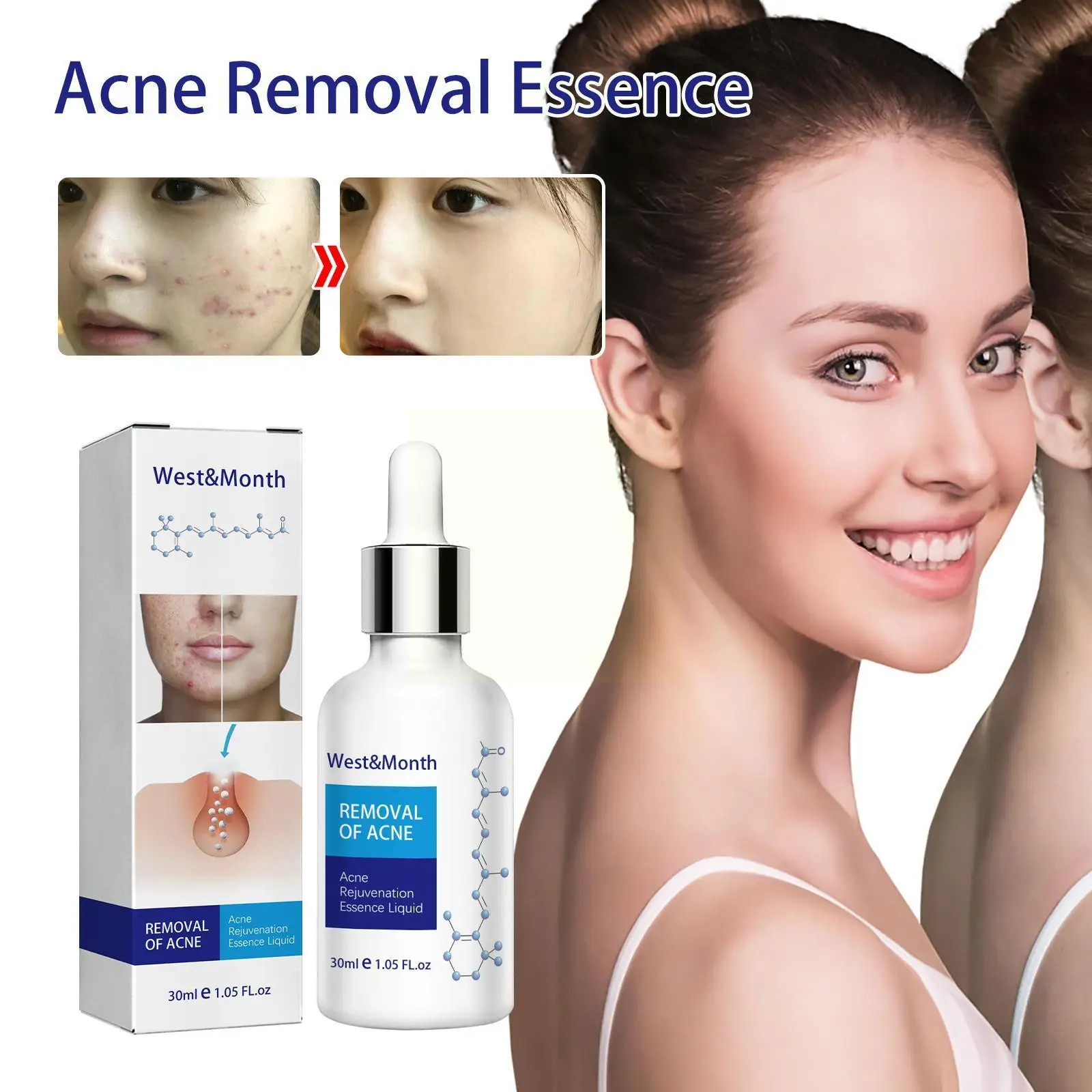 

30ml Acne Removal Essence Treatment Acne Scar Spots Control Pores Moisturizing Face Oil Whitening Care Anti-acne Shrink U9w6