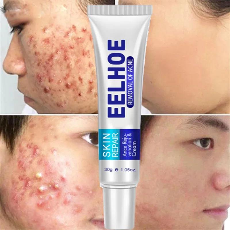 

Травяной эффективный крем для удаления акне, традиционное устройство для сокращения пор, освежающее увлажнение