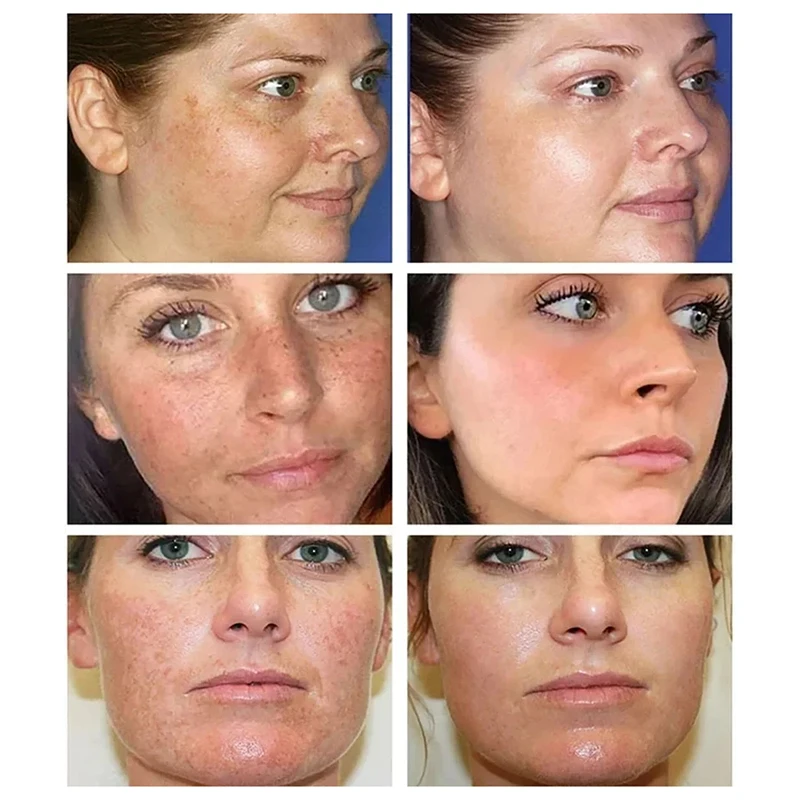 Эффективный отбеливающий крем для лица с астрагалом удаление темных пятен