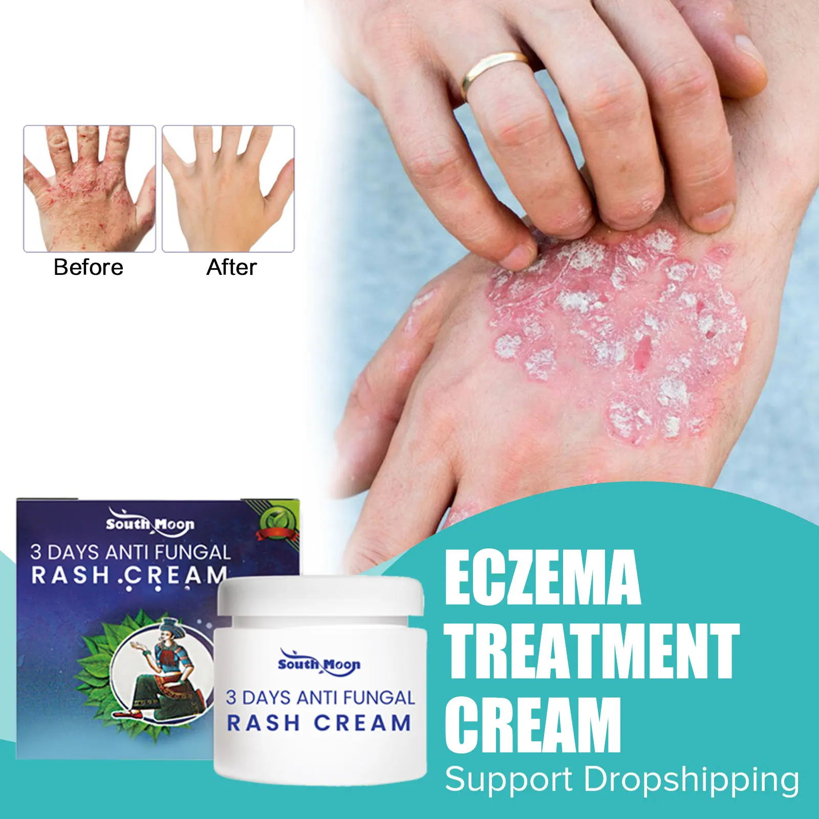 

Anti-Itch Psoriasis Ointment Effective Against Fungi Dermatitis Treatment Eczema Allergy Skin Pruritus Rash Antibacterial Cream