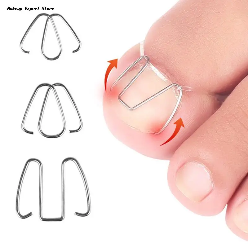 

Comfortable Ingrown Toenail Pedicure Tool Straightening Correction Clip Curved Brace Toenails Thick Paronychia Correction