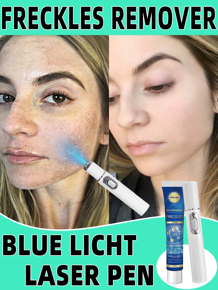 Лазерные веснушки хлоазма темные пятна от солнца