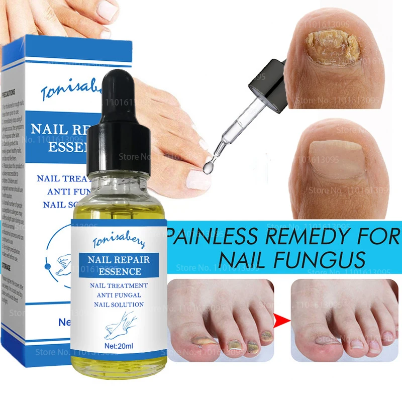 

Nail Fungal Treatment Feet Care Essence Nail Foot Care Toe Nail Fungus Removal Gel Anti Infection Paronychia Onychomycosis 20ML
