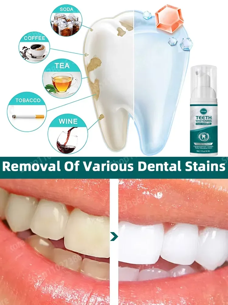 Le nettoyage des dents a un effet blanchissant efficace contre les taches profondes Tooth Whiten Care