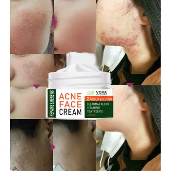 Acne Removal Cream Skin Care Beauty Health Anti Acne Cream Face Female  Whitening Cream Spots Oil Control Shrink Pores 1
