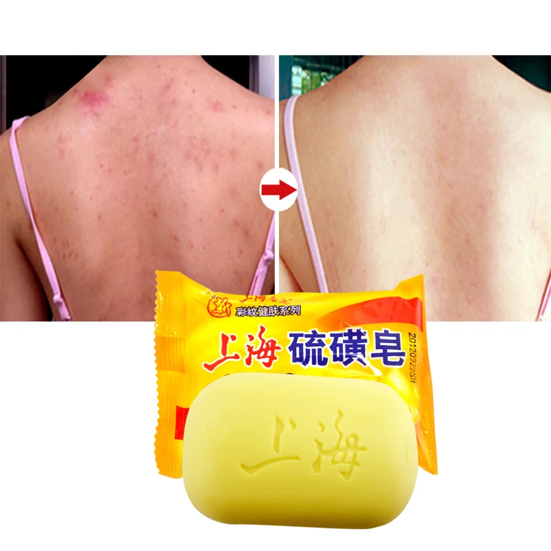 

85g Shanghai Sulfur Soap Oil-Control Acne Treatment Psoriasis Seborrhea Eczema Anti Fungus Bath Healthy Soaps Eczema