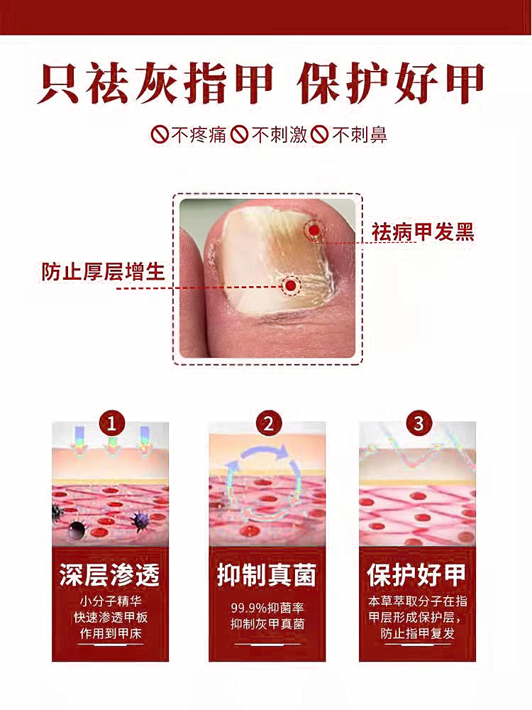 [Watsons Hot Sale] It Is Invalid to Remove 99% Gray Potassium Fungus by Dropping a Drop of Antibacterial and Not Removing Nail!!
