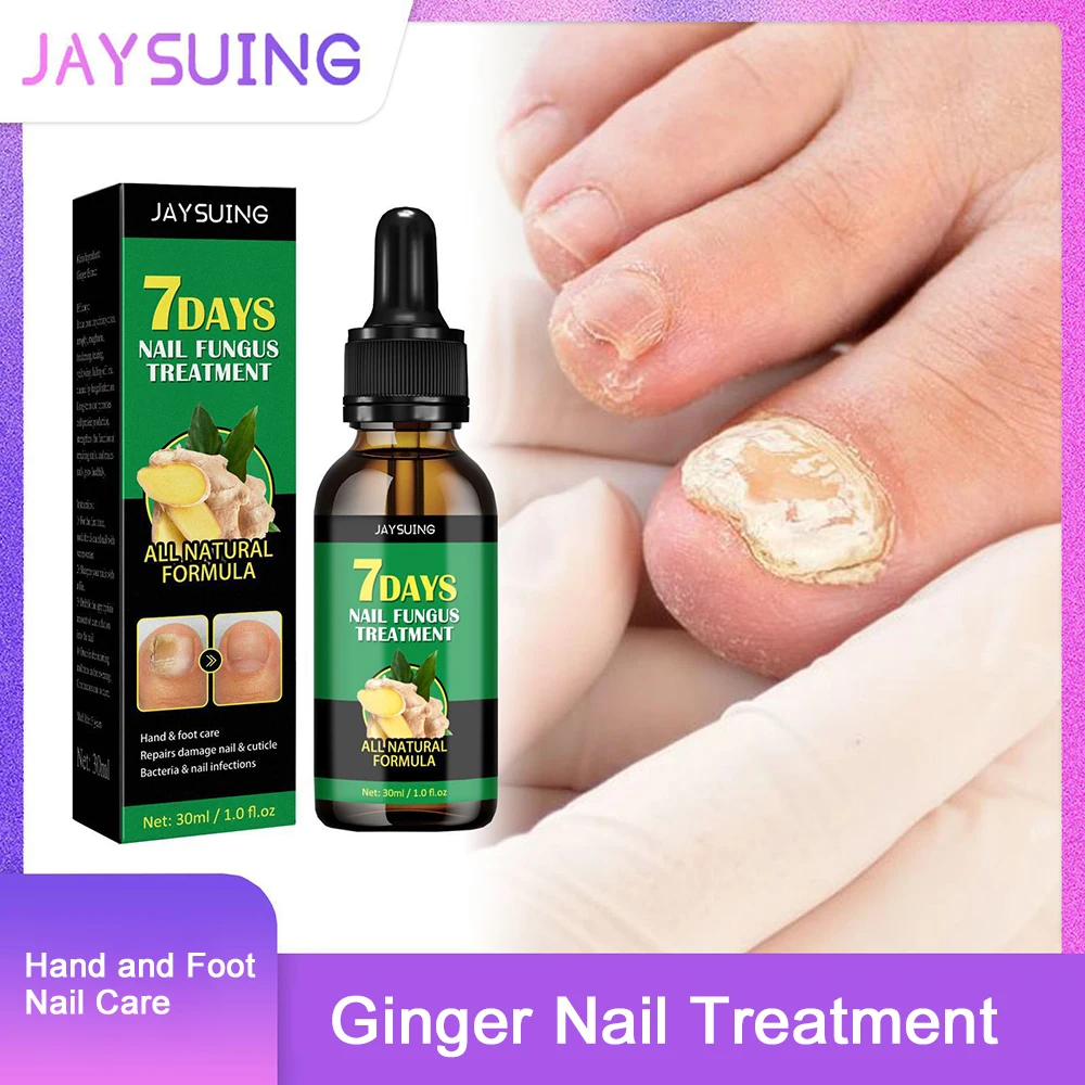 

30ml Ginger Nail Fungal Treatment Hand Foot Care Essence Paronychia Removal Fungus Liquid Toenail Onychomycosis Infection