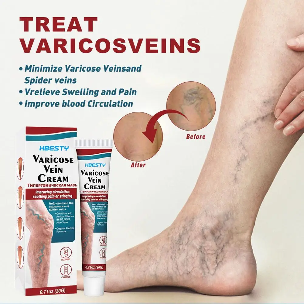 

Varicose Vein Treatments Cream Effective Relieve Legs Dilated Vasculitis Phlebitis Natural Formula Ointment For Varicose Veins