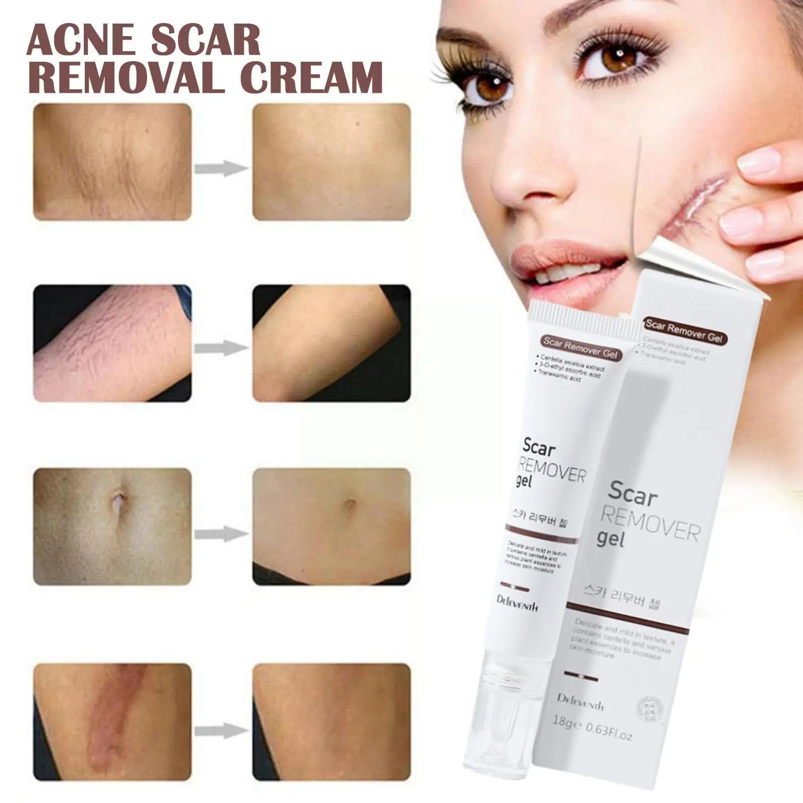 

Acne Scar Removal Cream Repair Maternity Stretch Marks Burn Treatment Scar Scars Surgical Remove Smooth Lighten Damaged Ski I7p6