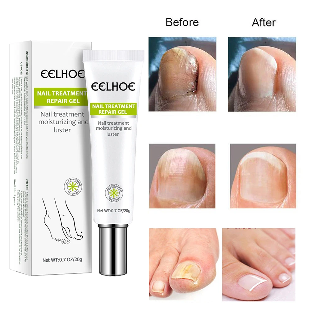 

Fungal Toe Feet From Nail Fungus Treatment Anti-fungal Infection Foot Paronychia Onychomycosis Toe Nail Treatment Cream