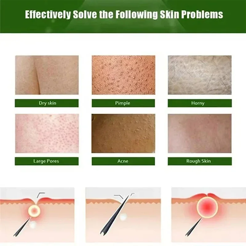 Крем для удаления куриной кожи крем тела уменьшает и удаляет омертвевшие клетки