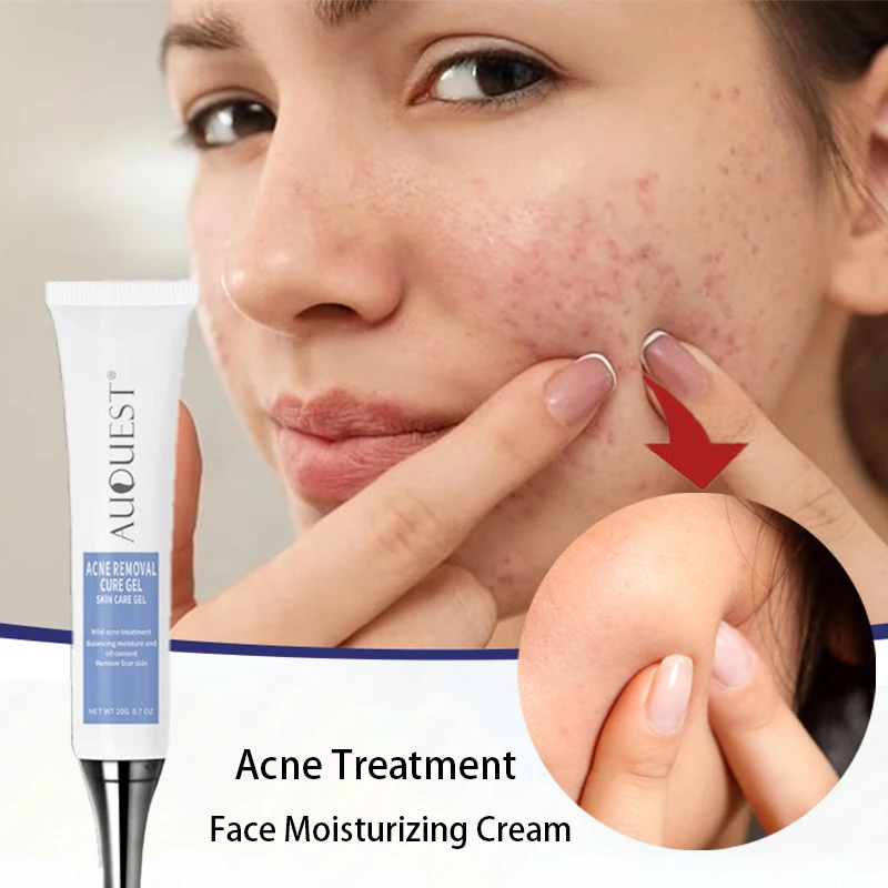 

Травяной крем от прыщей Удаление темных пятен и шрамов Гелевые продукты Контроль жирности лица Сужение пор Отбеливание Уход за кожей лица