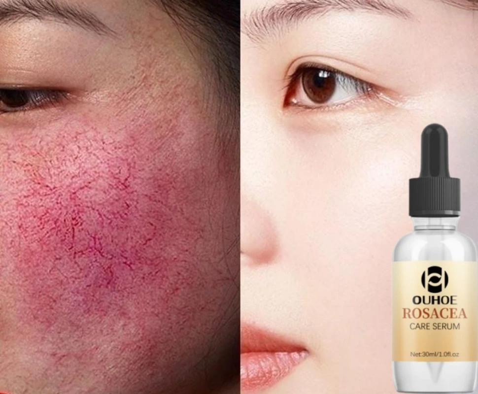 

Repair Facial Redness Essence Instant Spider Vein Removal Sensitive Skin Sooth Anti Redness Shrink Pores Lotion Korean Cosmetics