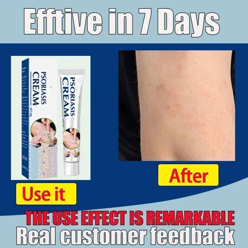 ГОРЯЧАЯ ПРОДАЖА антимикробное травяное лечение псориаза дерматит экзема мазь