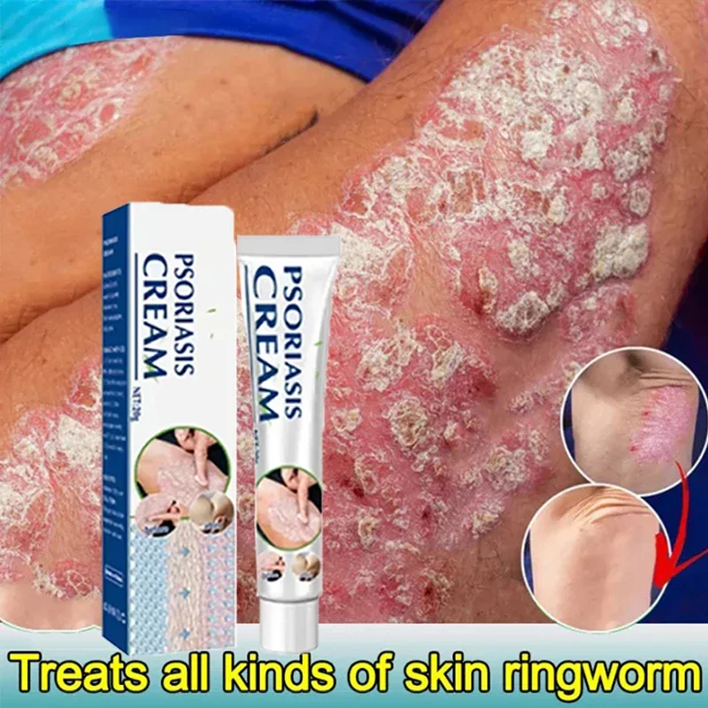 Псориаз экзема экзематоидный дерматит антибактериальный уход за кожей против