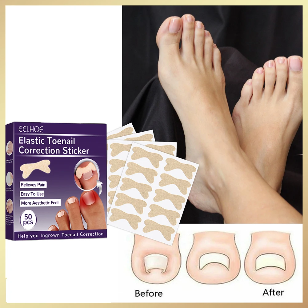 

100 шт., наклейки для коррекции вросших ногтей