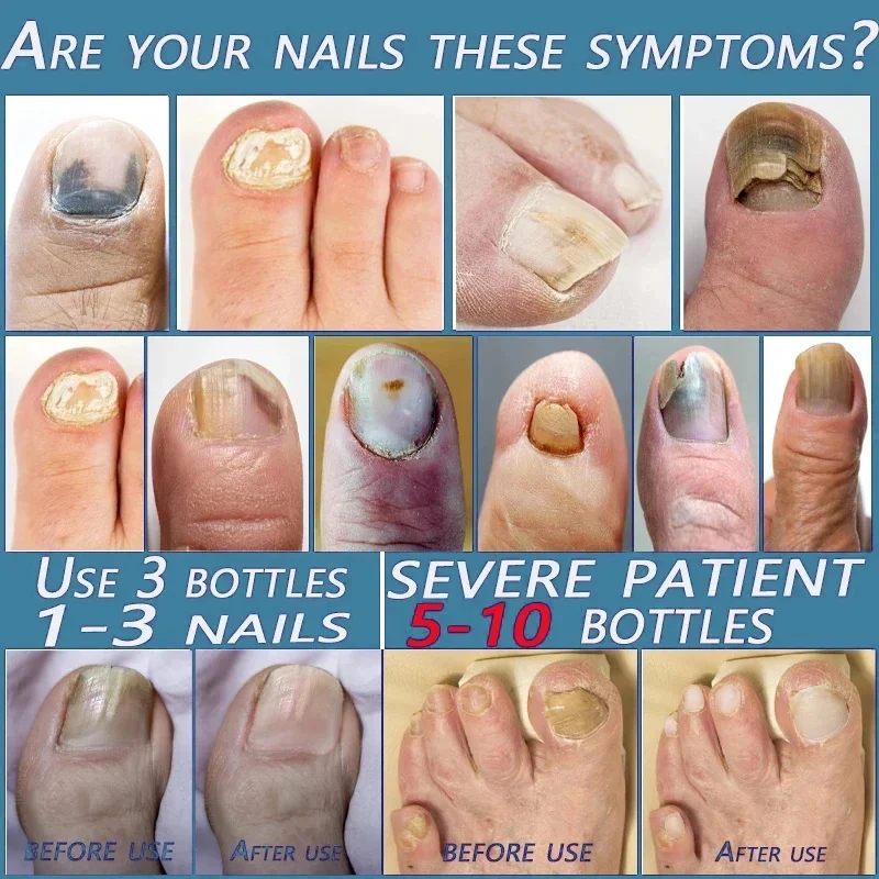 Сыворотка для лечения грибка ногтей восстановление ног жидкий гель удаления