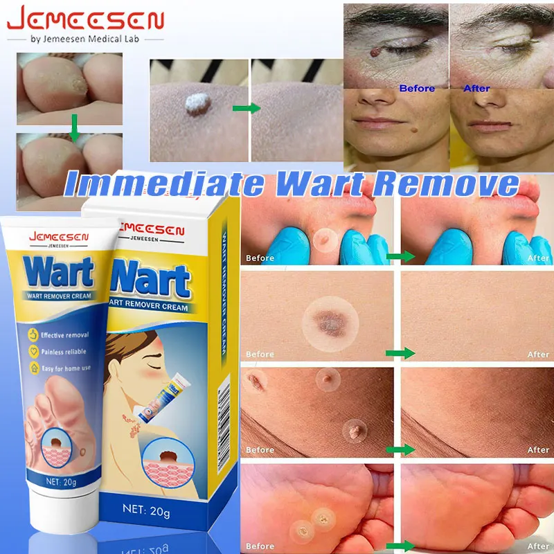 

Jemeesen Wart Remover Skin Tag Corrector Cream Painless Mole Skin Warts Remover Serum Freckle Face Wart Tag Treatment Removal
