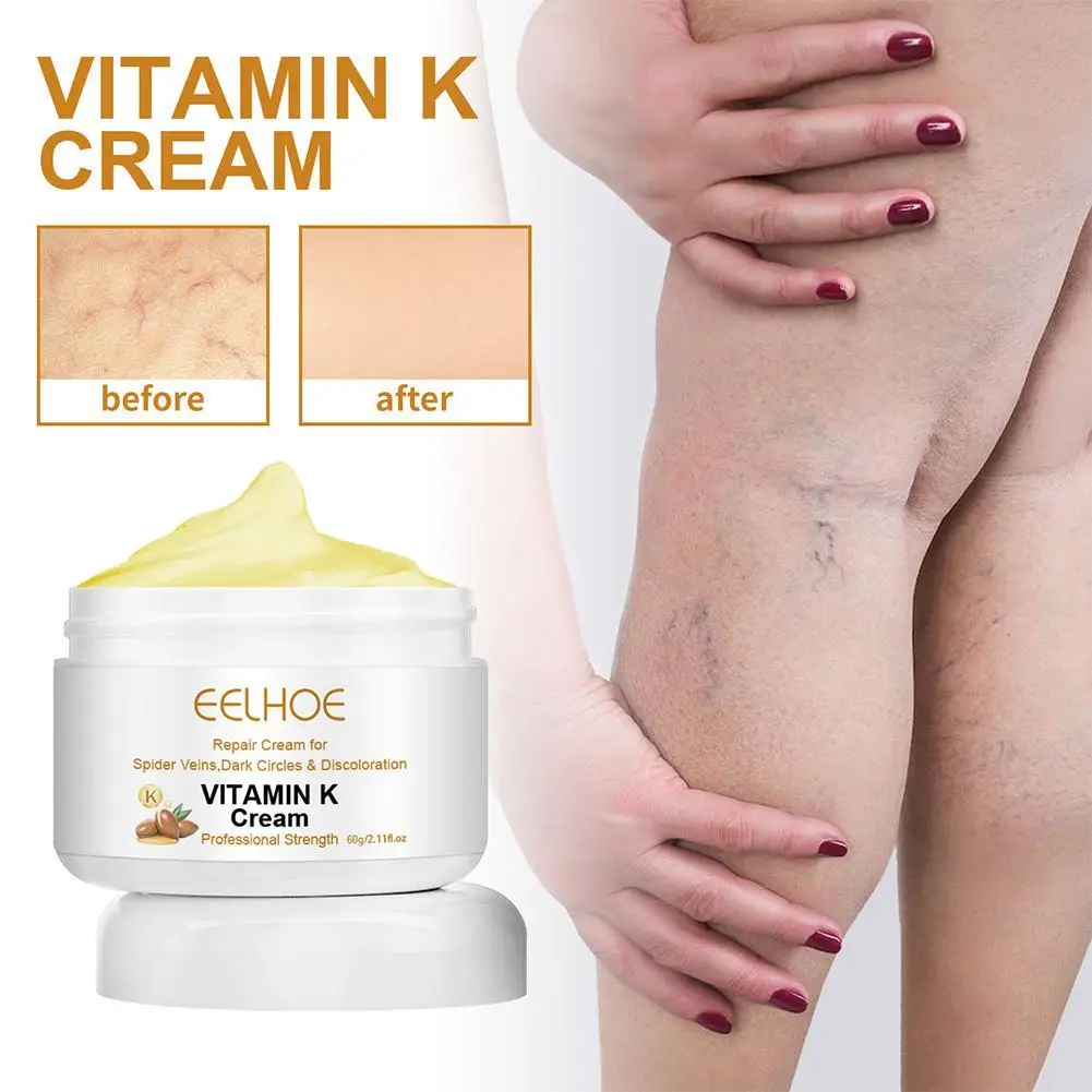 

60g Varicose Veins Effective Varicose Vein Ointment Relief Cream To Relieve Leg Vasculitis Phlebitis Spider Pain Swelling Care