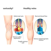 varicose veins patches reduce swelling relieve pain spider veins phlebitis leg relief patch soothing angiitis health care