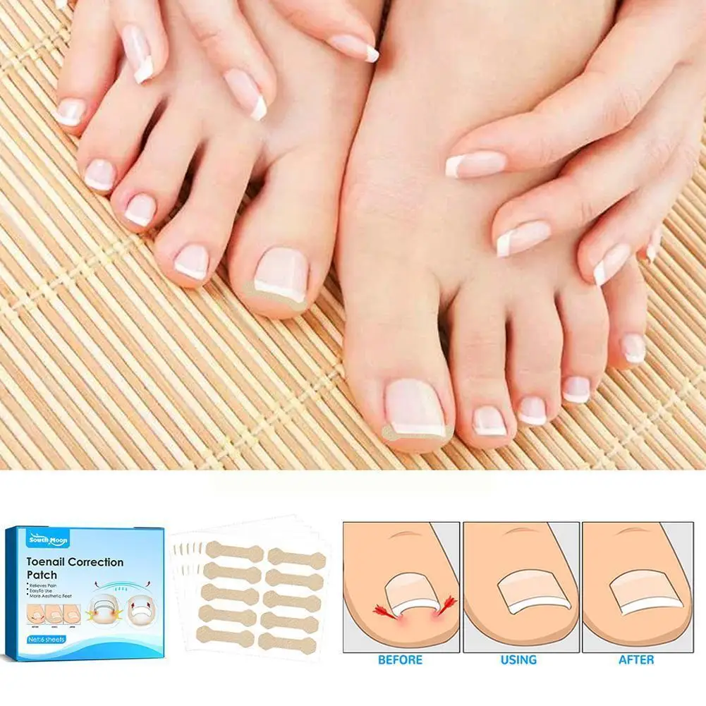 

Nail Correction Stickers Waterproof Ingrown Toenail Corrector Pedicure Tools Paronychia Pat Treatment Recover Hot F6x7