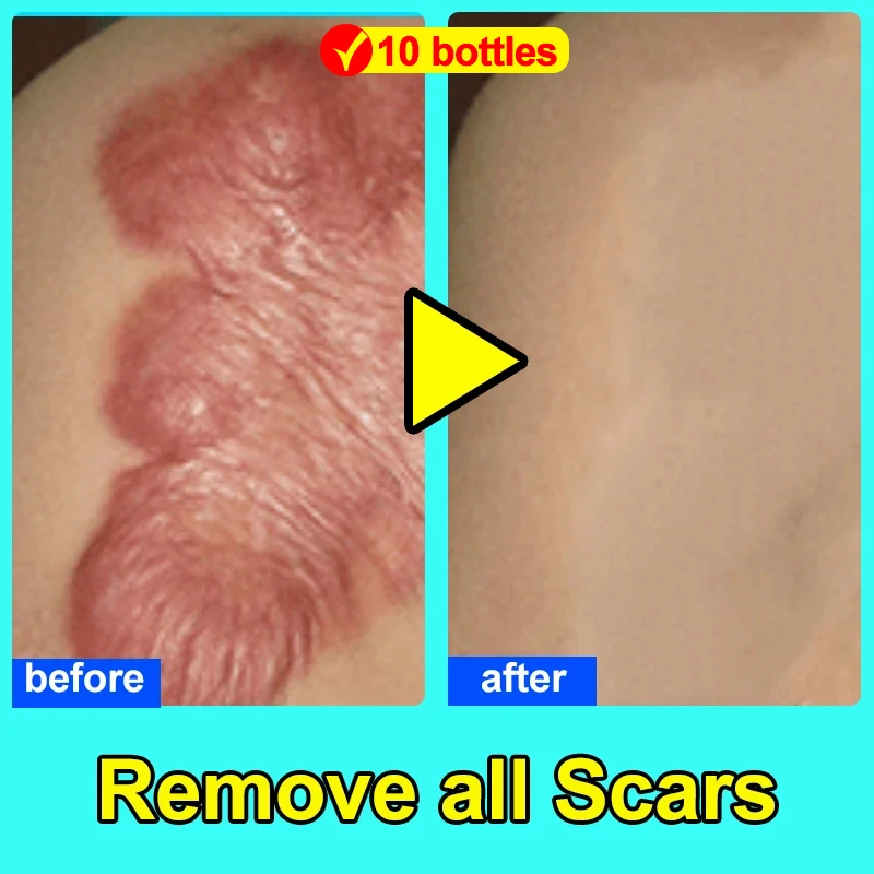 

Scar Removal Cream Scar Repair Gel Fade Scars Burns Caesarean Section Stretch Marks Surgical Scars Hyperplasia Scars