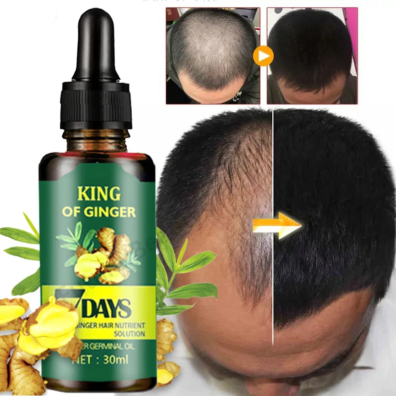 

Имбирная кожа, натуральная лампа, предотвращает облысение, подходит для мужчин, женщин и мужчин