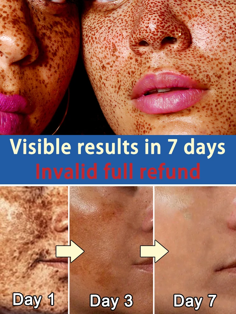 skutecznie usuwa ciemne plamy