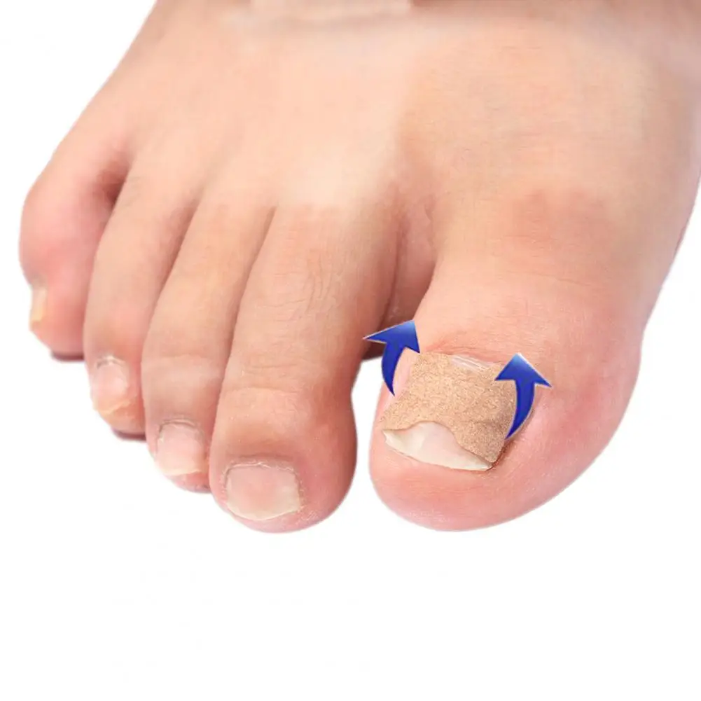 

Health Care Tool Portable Ingrown Toenail Correction Bandage for Women