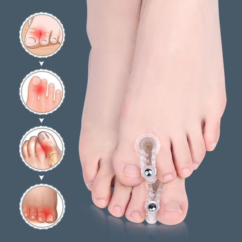 

2pieces=1pair Gel Separators Silicone Toe Splitter Orthosis Clip Pads Big Thumb Foot Bone Hallux Valgus Bunion Overlapping