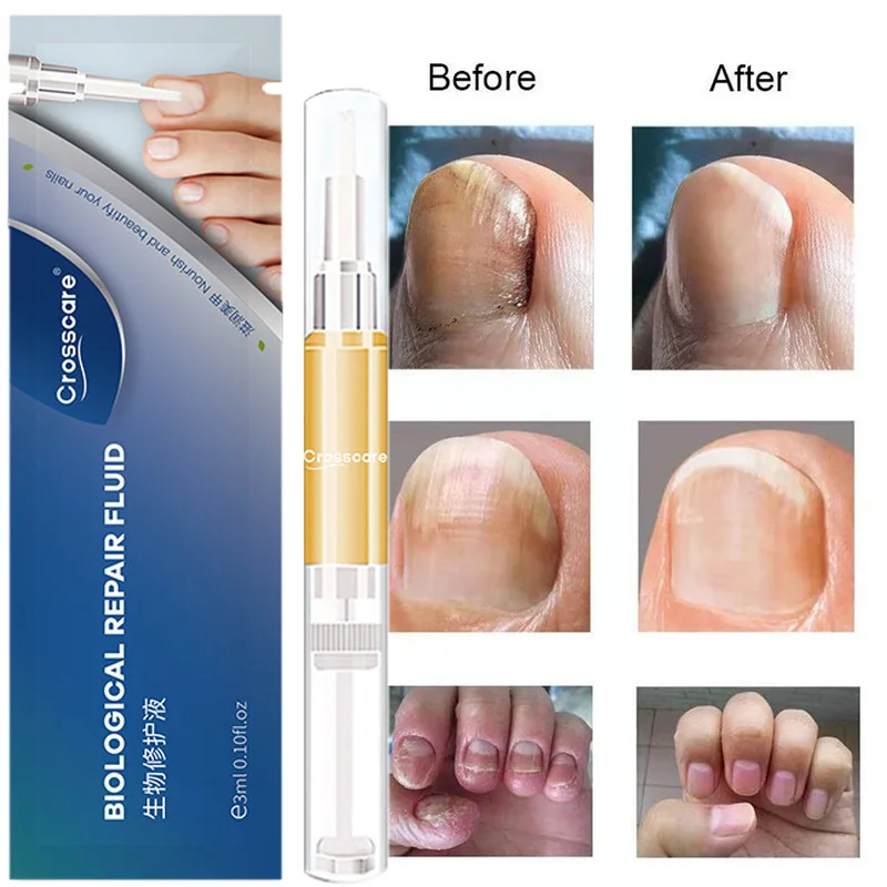 

Fungus Nail Treatment Pen 7DAYS Repair Feet Care Essence Onychomycosis Paronychia Anti Infection Toe Care Beauty Health