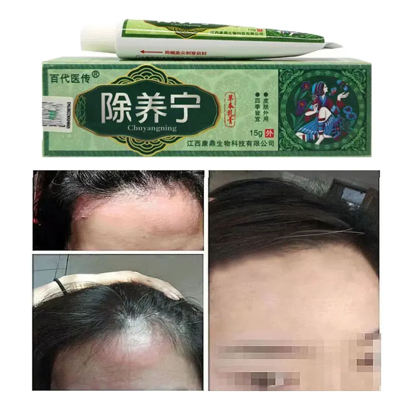 

Psoriasis Cream Perfect For Dermatitis and Eczema Pruritus Adults And Children 15G