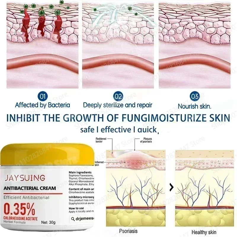 Мазь от псориаза идеально подходящая для проблем на коже крем противозудный