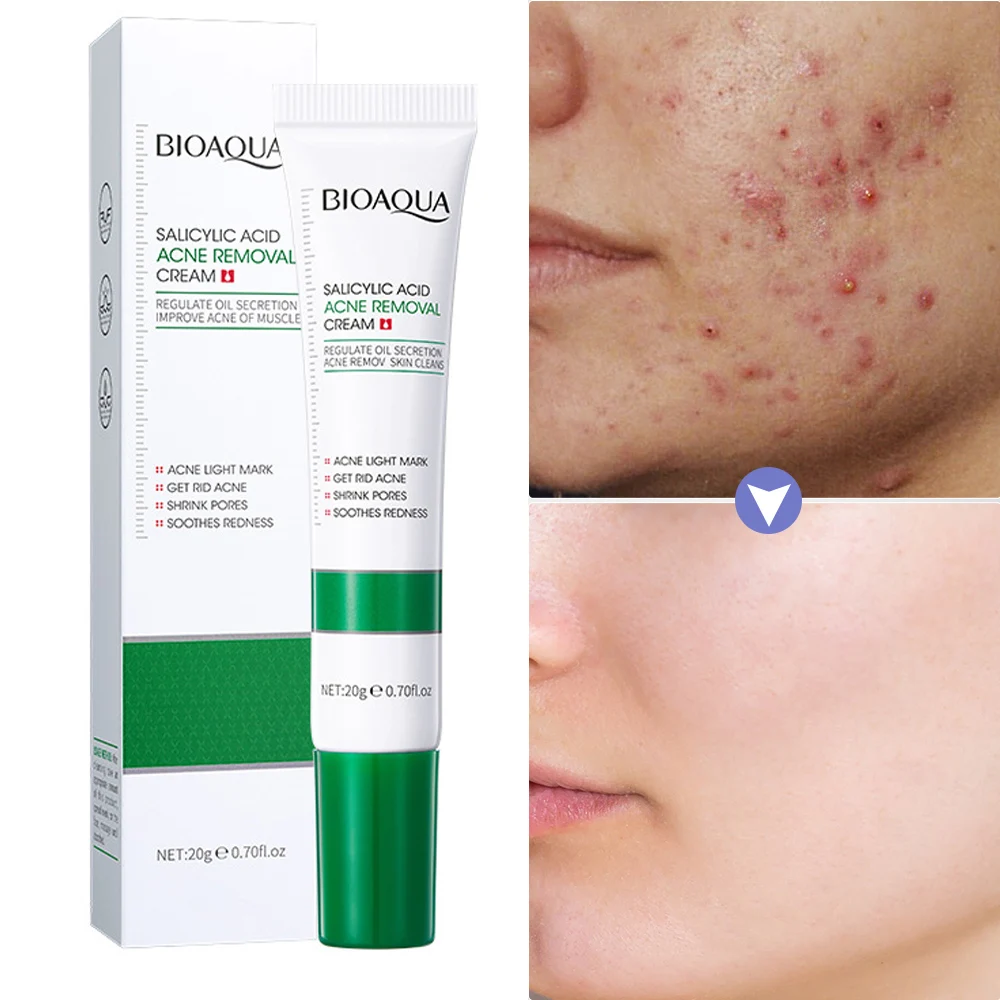 

Acne Treatment Cream Salicylic Acid Blackhead Pimple Remover Pore Shrink Deep Clean Products Moisturizer Whiten Face Skin Care