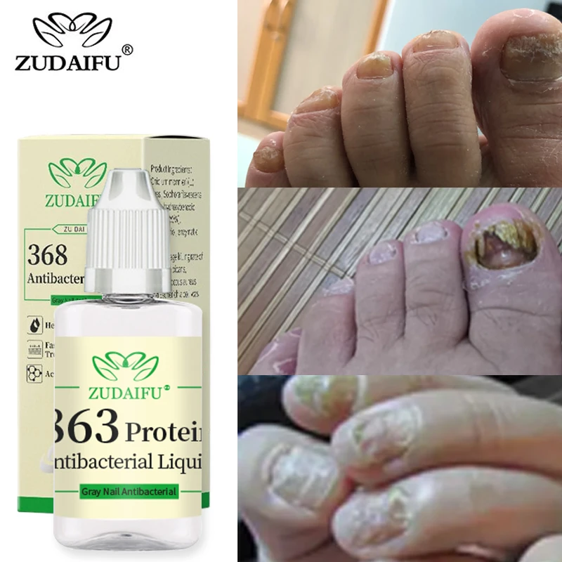 

ZUDAIFU Foot Nail Fungus Treatment Serum Anti Fungi Feet Care Against Fungal Nail Polish Oil Antifungal Drops Removes Gel 20ml