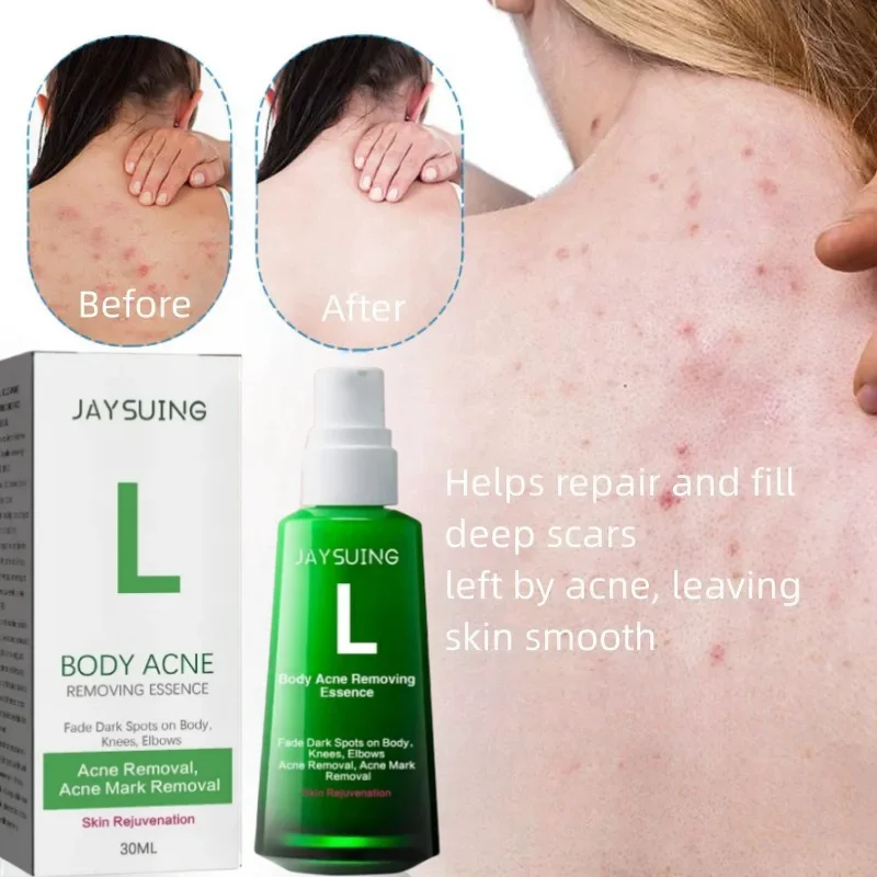 

Natural Hip Acne Removing Essence Lighten Acne Spots Melanin Whiten Moisturize Anti-Bacterial Skin Care Emulsion Korean skincare