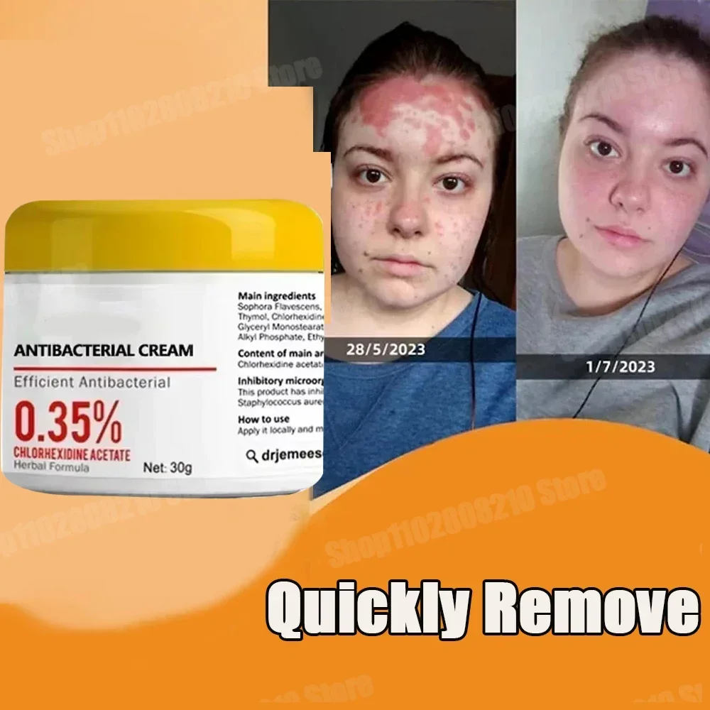 Крем от псориаза экзема кожи головы псориаз опояскивание рук запах ног щетина