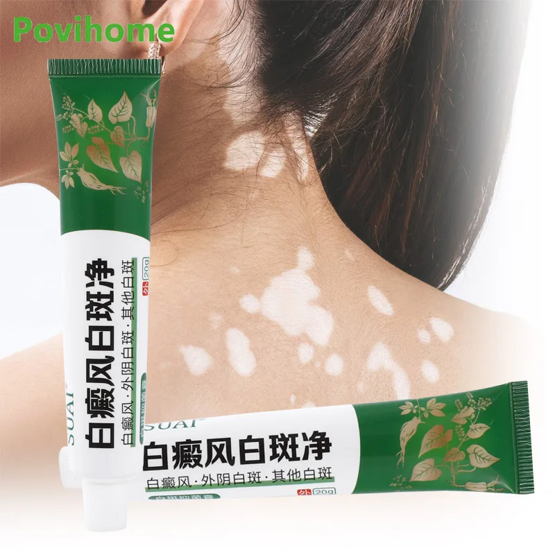 

1Pcs 20g Vitiligo Treament Ointment White Spot Antibacterial Cream Remove Skin Leukoplakia Melanin Health Care Herbal Plaster