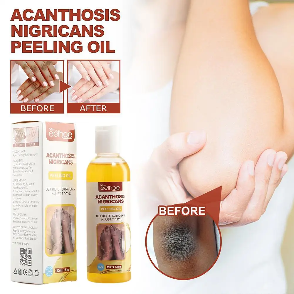 

110ml Exfoliating Body Oil Acanthosis Nigricans Peeling Arm Whitening Even Skin Elbows Care Body Oil Skin Tone I2S6