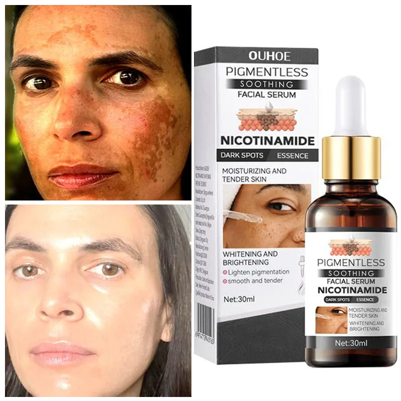 

Remove Dark Spots Face Serum Lighten Melasma Melanin Correcting Repair Essence Anti Freckle Brighten Whitening Korea Cosmetics