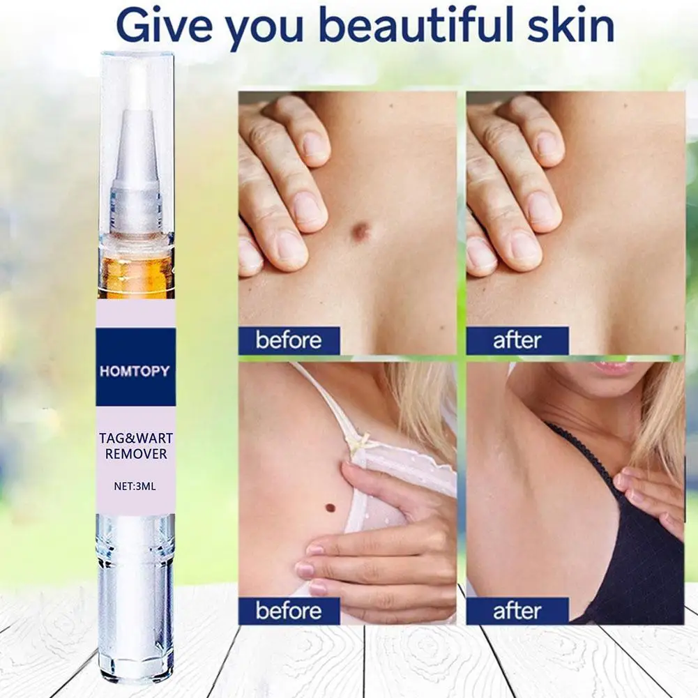 

1 шт., антибактериальный гель для удаления бородавок и бородавок